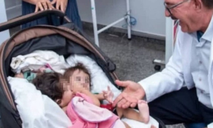 Kiraz e Aruna, le gemelle siamesi unite da torace, stomaco e bacino e separate dopo un intervento lungo 19 ore