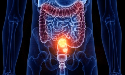 Screening gratuito per la prevenzione del tumore al colon retto