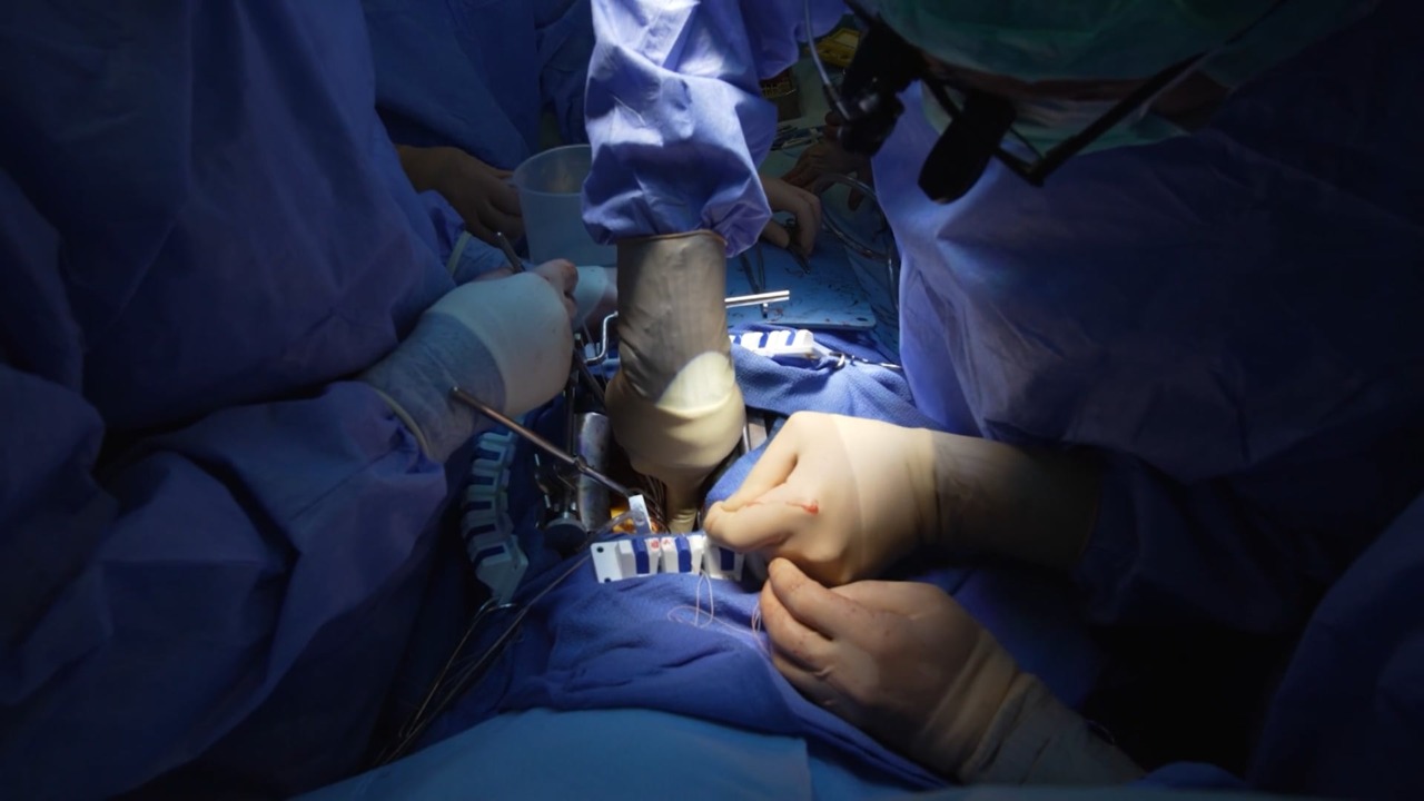 Ospedale Maggiore, eseguito un trapianto di organi da donatore a cuore fermo