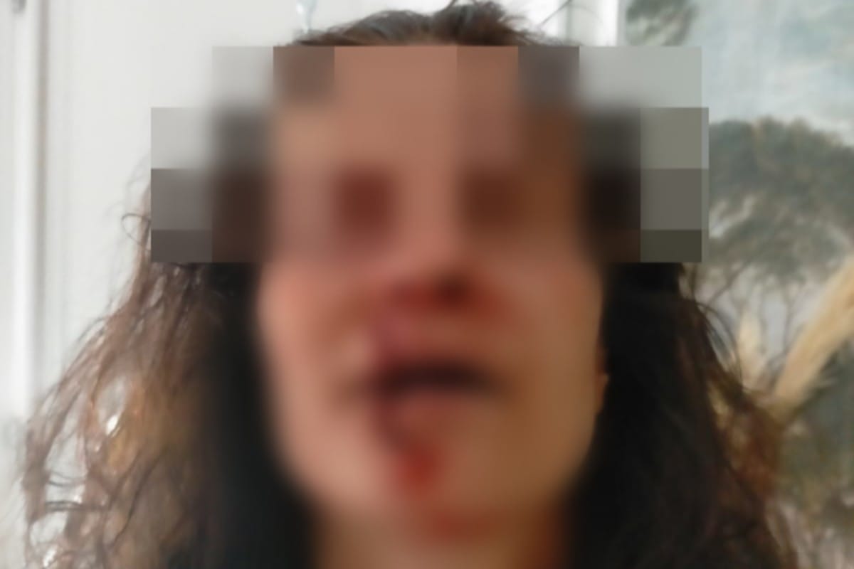 Sfregiò la vicina di casa con una tazzina: chiesti 5 anni di carcere