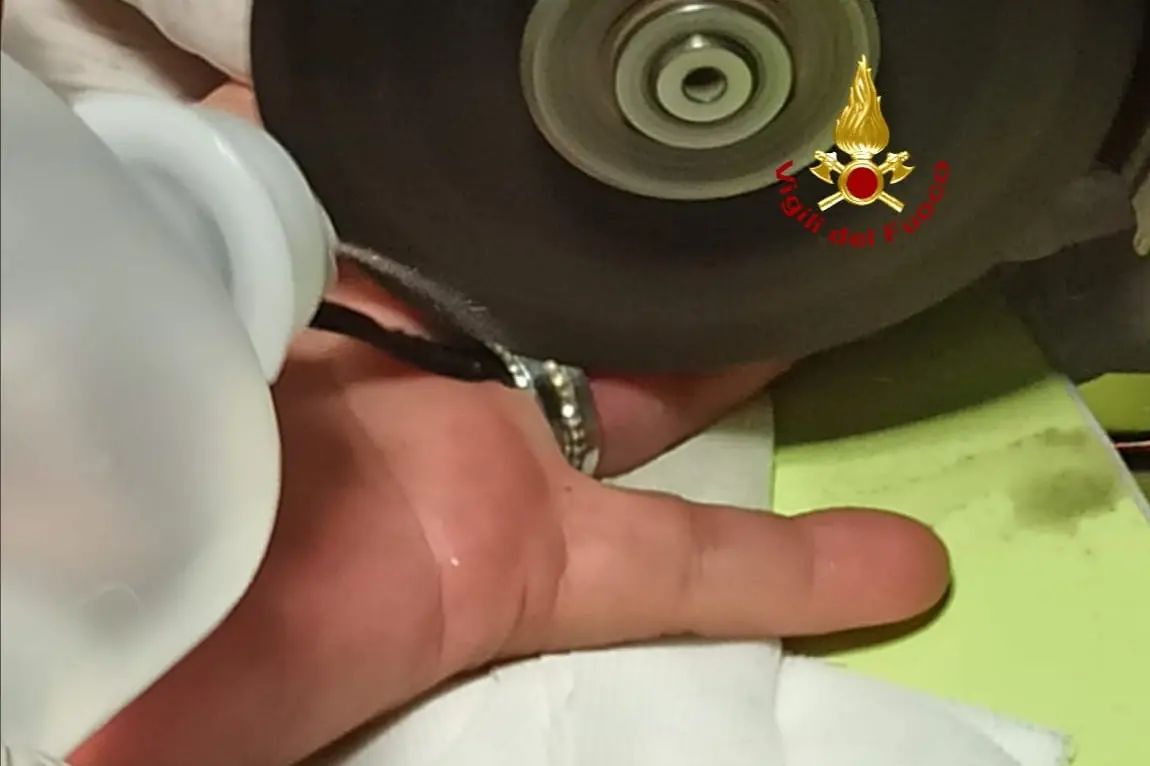 L’anello al dito bloccato da un gonfiore